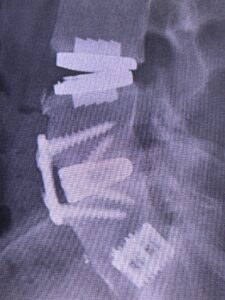 Aaron's X-ray imaging showing his hybrid fusion and artificial disc replacement