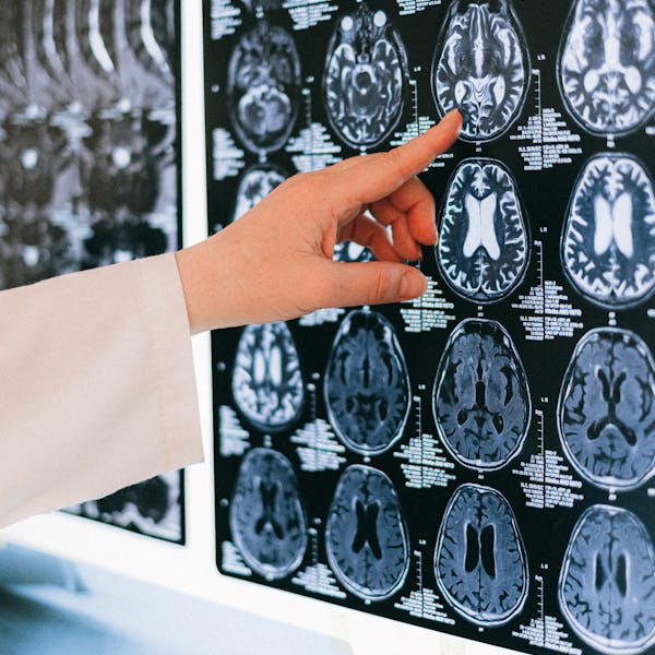 A doctor's hand points to a brain MRI scan on a lightbox, illustrating medical diagnosis.