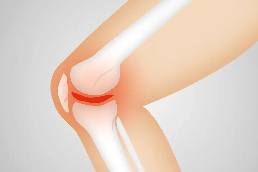 arthritis knee illustration