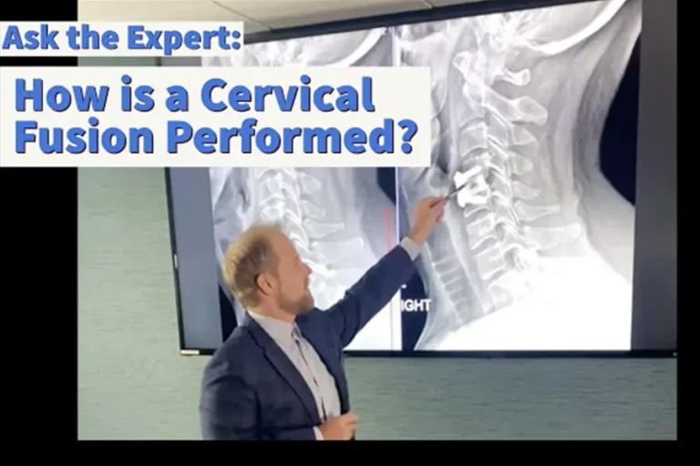 crg explaining cervical fusion