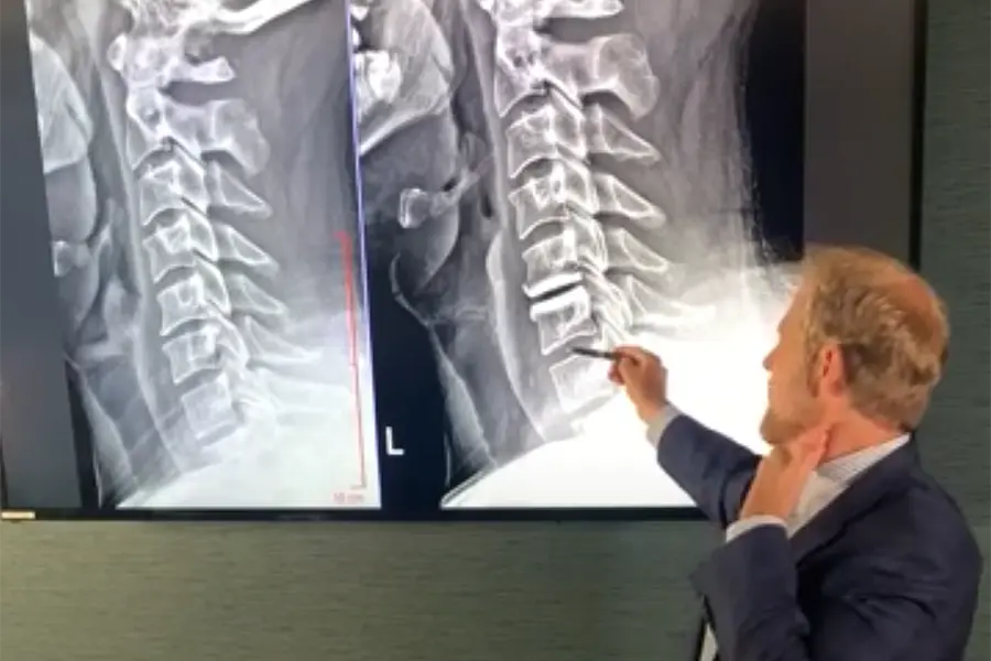 crg cervical spine surgery