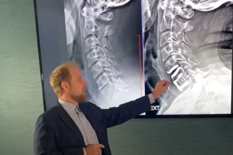 crg explains two level hybrid cervical surgery