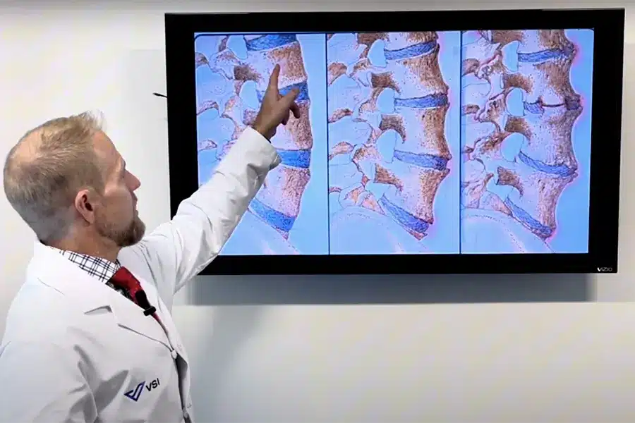 dr. good explains lumbar spinal stenosis