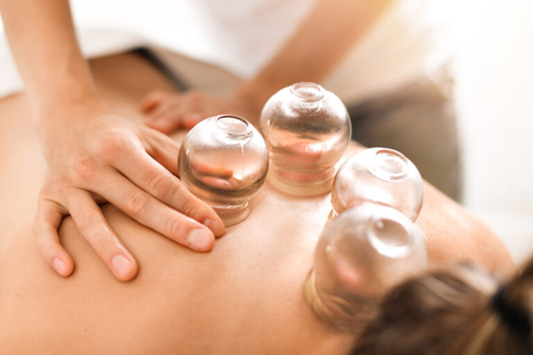 The 411 on Cupping as Treatment for Sore Muscles