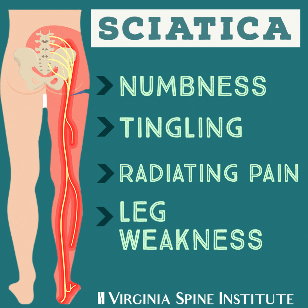 How Physical Therapy Can Jumpstart Your Sciatica Treatment - VSI