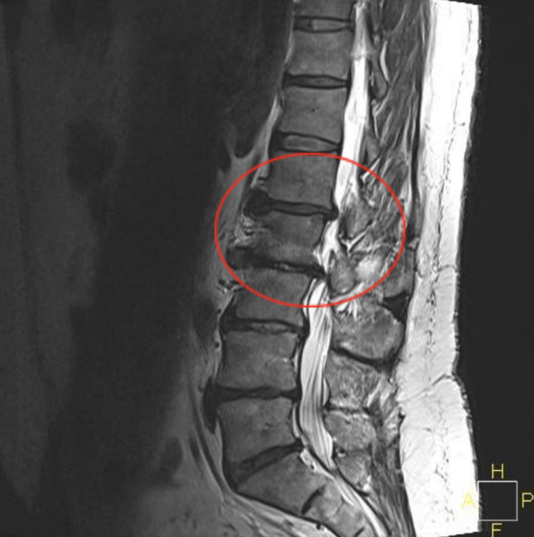 Lumbar spinal stenosis MRI