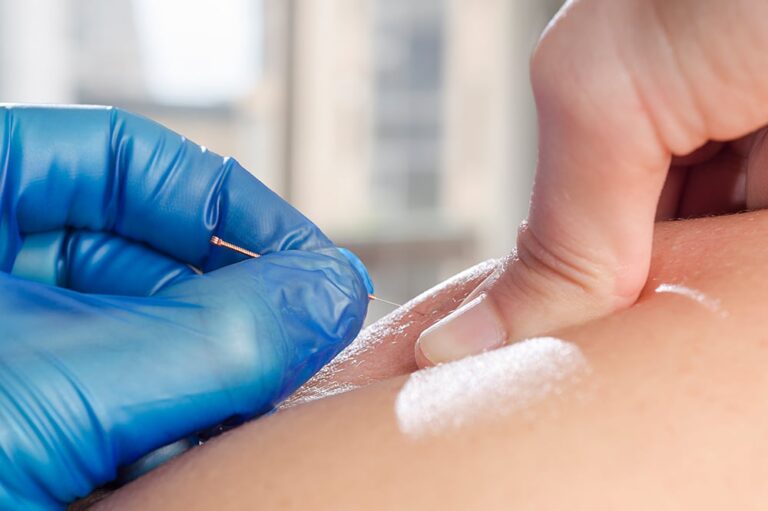 Tired Of Nagging Muscle & Joint Pain? Dry Needling Is The Answer!