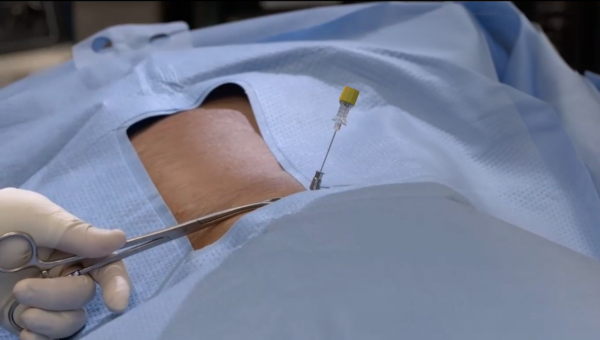 viadisc procedure